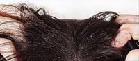 Get rid of dandruff with simple ingredients,home made products!!!